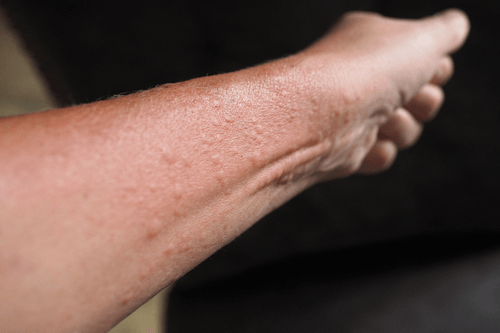 Hives Facts Causes Allergic Response Treatment Prevention Factdr