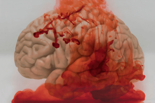 Internal bleeding brain