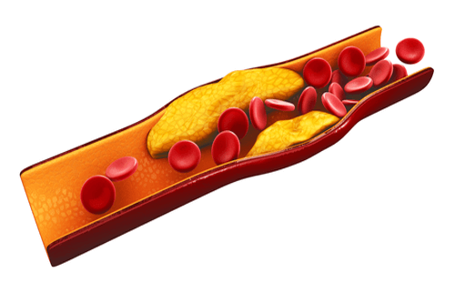 LDL cholesterol artery