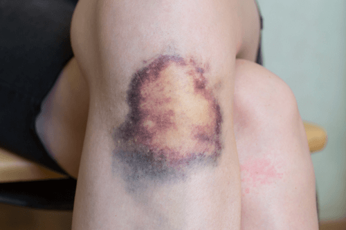 MYELODYSPLASTIC SYNDROMES bruising