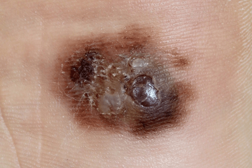 Melanoma diagnosis