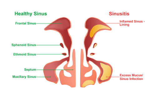 non-allergic-rhinitis-facts-triggers-symptoms-diagnosis