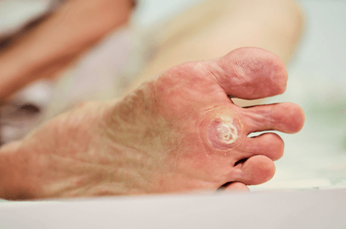 PLANTAR WARTS