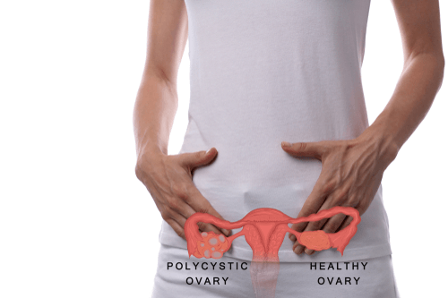 POLYCYSTIC OVARY SYNDROME