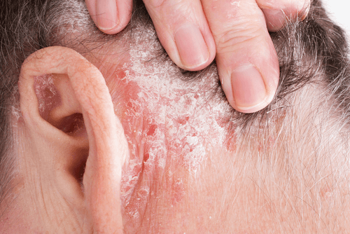 PSORIASIS scalp