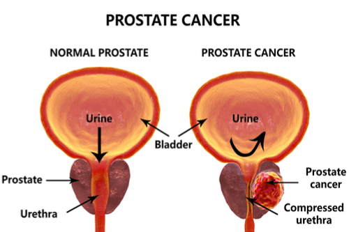 Prostate Cancer   Facts Risk