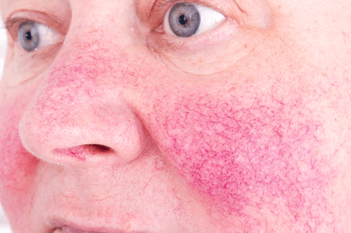 Rosacea skin