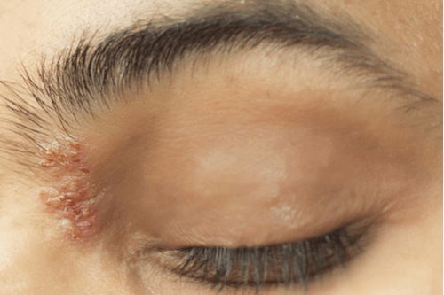 SHINGLES (HERPES ZOSTER) eyes