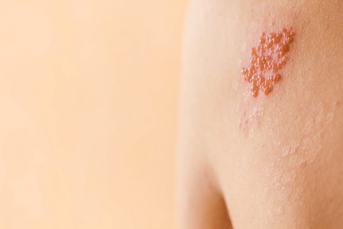 SHINGLES (HERPES ZOSTER)