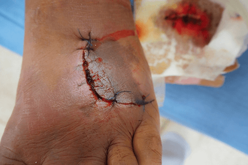 STAPH INFECTION stitches