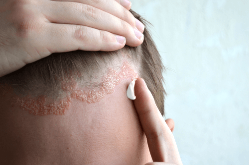 scalp psoriasis and crohn's)