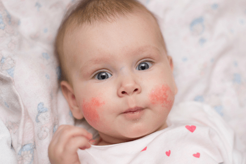 Skin problems in children _ allergies