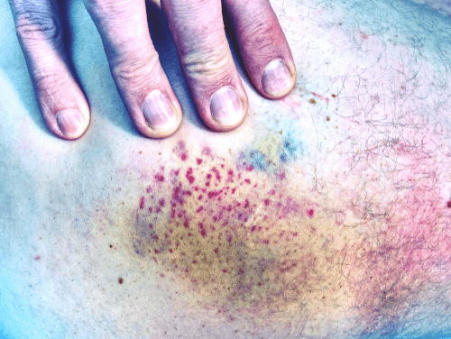 THROMBOCYTOPENIA purpura