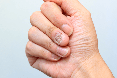 Nail Fungus Facts Causes Prevalence Symptoms Remedies