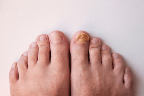 Nail fungus toes