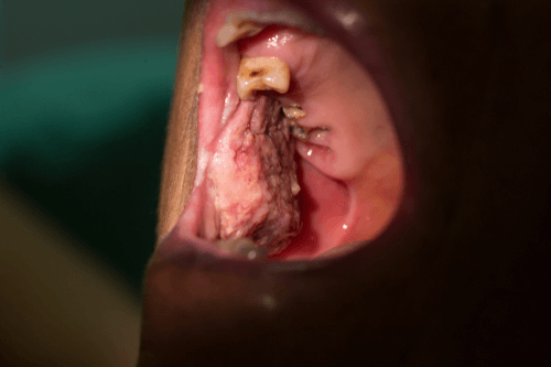 Oral leukoplakia cancer