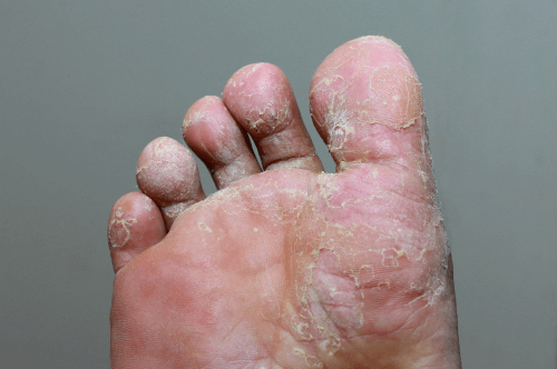 Athlete's Foot : Facts, causes, symptoms, genetics, treatment, & prevention  | FactDr