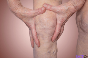 geriatric health arthritis