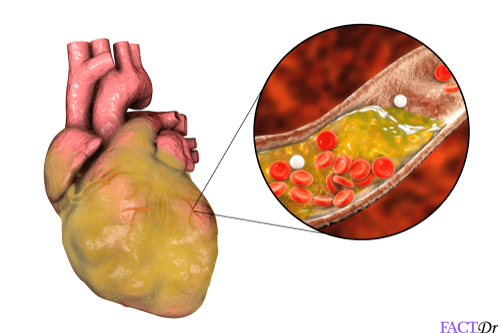 lipoprotein A