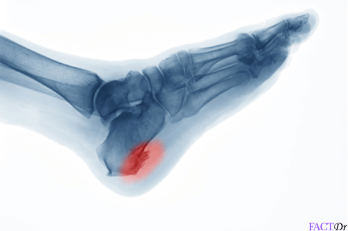 Heel spurs: Symptoms, pain, causes, treatment, & stretches - FactDr