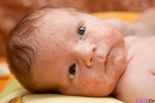 Baby Acne Symptoms Causes Skin Rashes Home Remedies Factdr