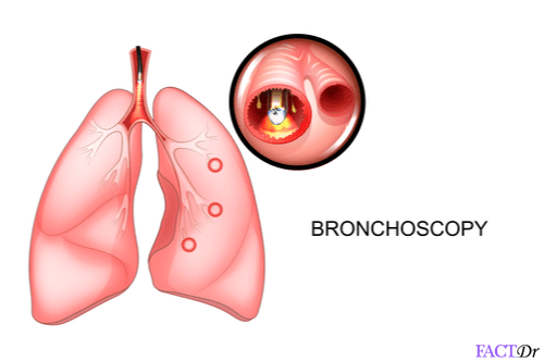 Bronchoscopy procedure