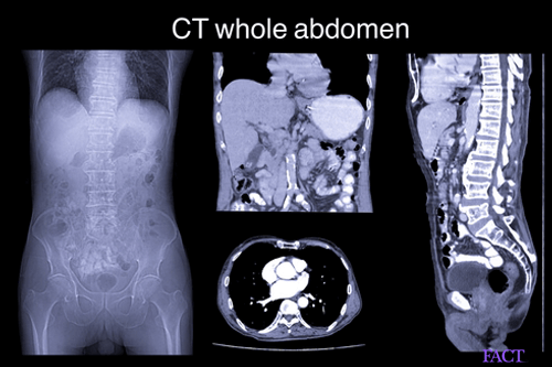 Abdominal Ct Scan Cost With Contrast Results Radiation - Factdr