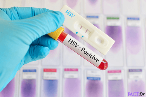 hsv igg test