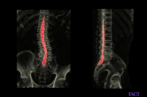 myelogram