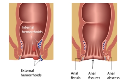 piles,fistula,fissures