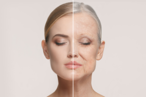Successful facelift surgery