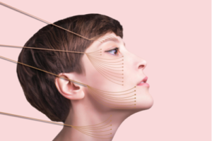 Facelift-surgery