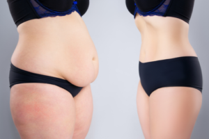 belly fat liposuction
