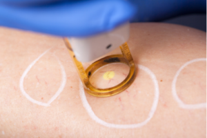 Laser treatment for spider vein