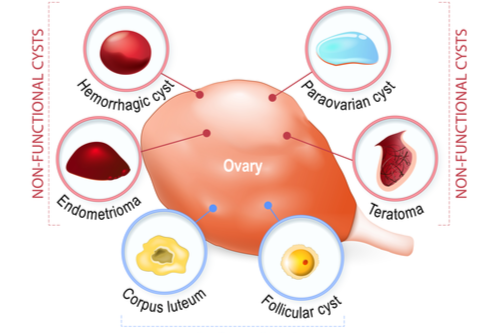 Ovarian cyst types