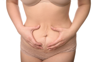Postpartum belly